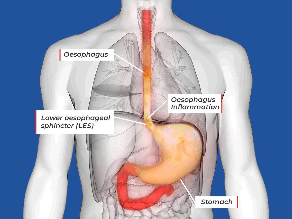 Acid reflux could mask a more serious health problem