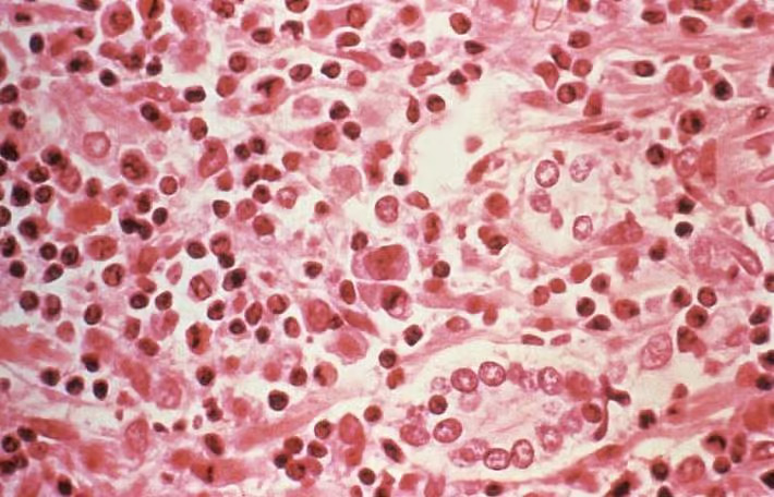 Not another Covid-19': UAE doctors allay hantavirus fears, explain low spread risk