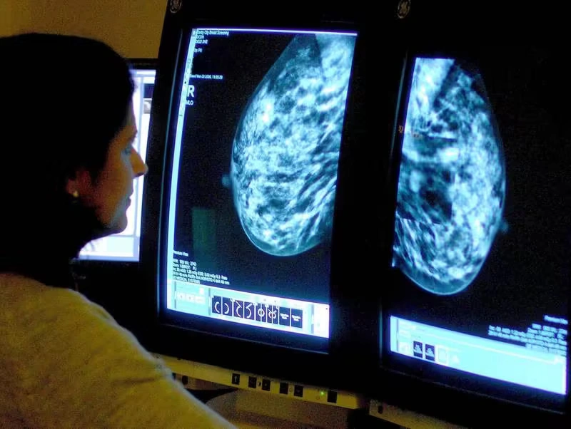Global cancer rates increase in people under 50
